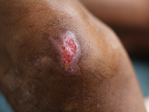wound infaction to skin  diabetes melitus.