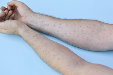 Monkeypox new disease dangerous over the world. Male hands affected by blistering rash because of monkeypox or other viral infection