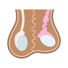 Illustration of normal testicle and testicle torsion in scrotum. Medical chart of reproductive organ anatomy.