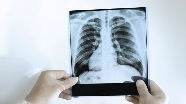 Close-up Tuberculosis on a human lung x-ray. The doctor analyzes the x-ray of the lungs on a white background. Medical worker taking an x-ray of the lungs in the hand. Pneumonia card