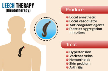 Medicinal leech therapy (MLT) or hirudotherapy Using leech to suction blood from human body