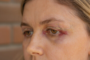 Double Eyelid Surgery, Eyes Surgery Recovery Period, immediately after plastic surgery. Eyes After Eyelid Surgery