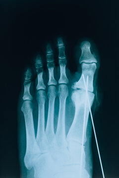 X-ray of the toes. Leg injury. Shot of the foot with pins