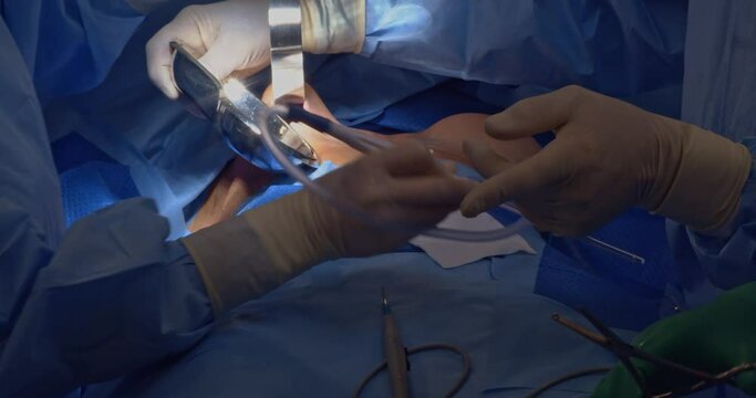 Breast implant replacement. Plastic surgery