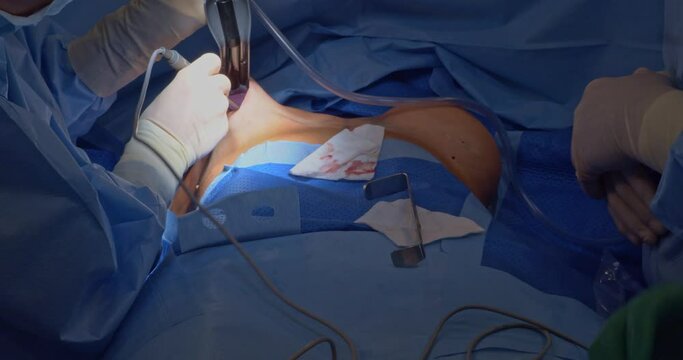 Breast implant replacement. Plastic surgery