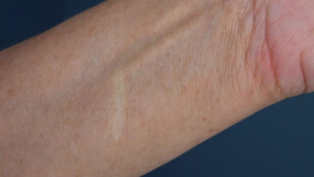An old scar from an accidental cut