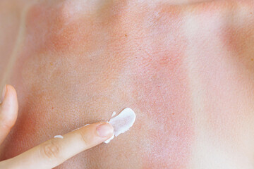 Woman's hand smears anti-burn cream on skin after sunburn