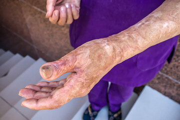 Scars after a burn on a woman's hand