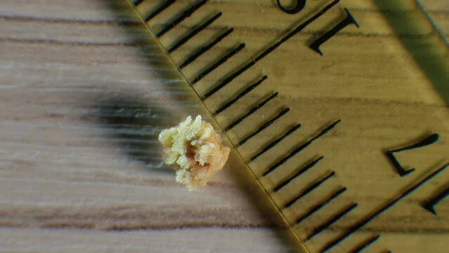 Oxalate kidney stone 4 mm, the stone was removed from the kidney, close-up of the kidney stone. Demonstration of a human stone after surgery.