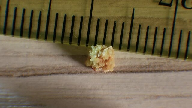  Oxalate kidney stone, the stone is removed from the kidney, close-up of the kidney stone. Natural stone formed in the human kidney