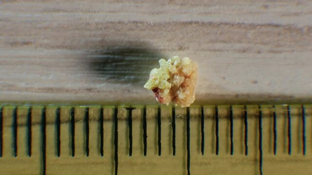 Oxalate kidney stone, stone removed from kidney, kidney stone close-up. Natural stone formed in the human kidney.