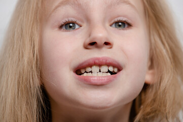 Girl shows teeth with a gap, malocclusion