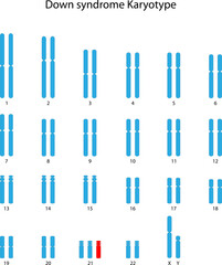 Down syndrome (trisomy 21) human karyotype