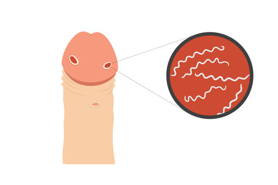 Medical chart of penis and syphilitic ulcers on its skin. Spiral bacterias in the microscope lens shown.