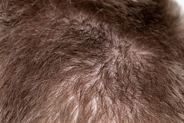 Hair loss adult man on a back of head. Irritated scalp skin.