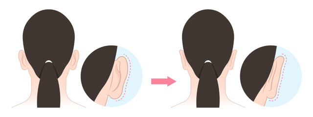 Back view of Ear pinned reshape Corrective lop earlobes deformities - obrazy, fototapety, plakaty