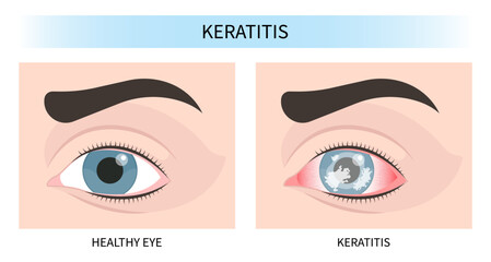 pupil iris scars injury pink red surfer's eye blurry ulcer bacteria lens vision loss pain sores tear drop trauma conjunctival cyst swelling itchy dry uvea Stye hordeolum pimple cellulitis Anterior