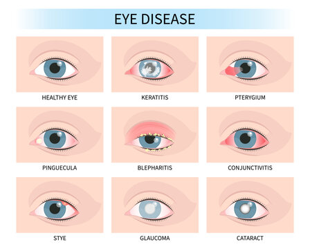 Stye eye lens injury pink red surfer's blurry ulcer bacteria vision loss pain sores tear drop scars trauma conjunctival cyst swelling itchy dry uvea hordeolum pimple cellulitis pupil iris Anterior	