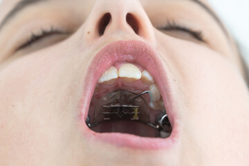 little girl with a plate on her teeth