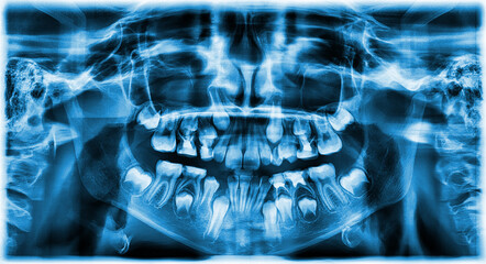 different types of wisdom teeth problems concept. Problem teeth X-ray image scanned