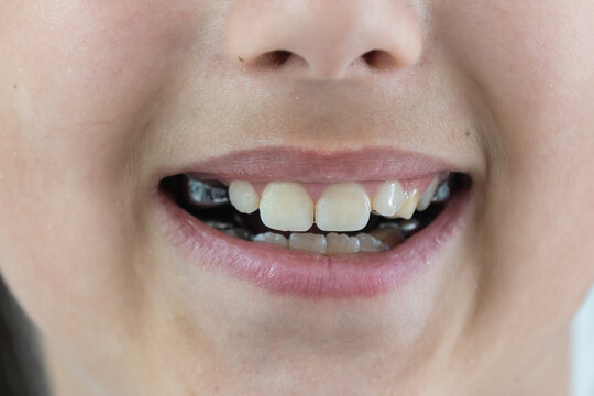 a little girl with a shifted dentition demonstrates her teeth