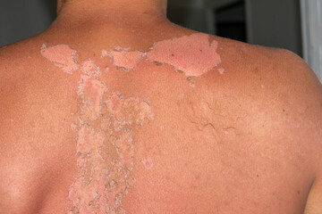 Peeling skin from a sunburn