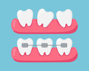 Crooked teeth and teeth with braces. Vector illustration