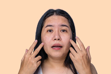 Asian adult woman face has freckles, large pores, blackhead pimple and scars problem from not take care for a long time. Skin problem face isolated yellow background. Treatment and Skincare concept