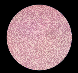 Microscopic view of hematological stained slide. thrombocytopenia. Extremely low level of platelet count in blood.
