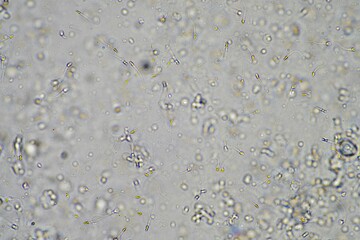 person with a virus coughing, Phlegm and mucus under the microscope