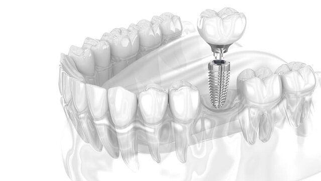 Dental Implant and ceramic crown. 3D animation of human teeth