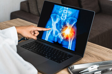Close up of doctor showing a x-ray of pain in the hips on a laptop. 