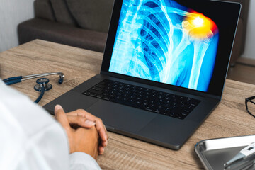 Doctor looking a x-ray of pain in the shoulder on a laptop. 