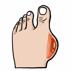 cartoon feet with high uric acid Origin of gout