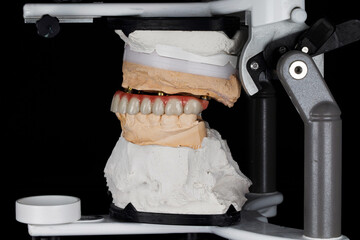 dental prosthesis of the upper jaw on the model in the bite and in the articulator on a black background © Dental Pro Content