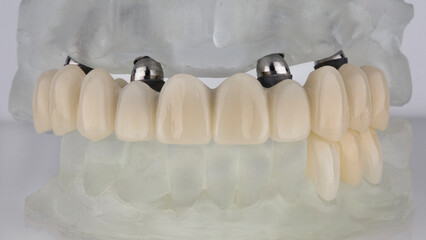 temporary dental prosthesis of the upper jaw on the beam and three crowns on the lower jaw, in the occlusion on models © Dental Pro Content