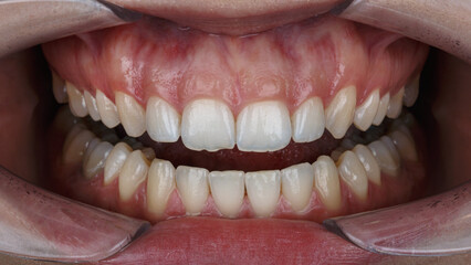 patient's upper jaw with gingiva for resection © Dental Pro Content