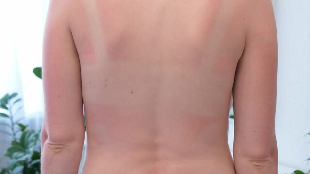 Close-up view of sunburn marks woman's back. Woman with reddened itchy skin after sunburn.