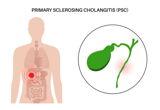 Primary sclerosing cholangitis
