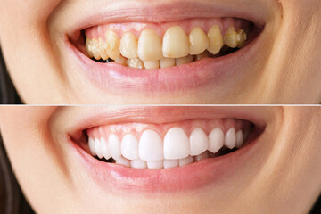 A woman's smile in close-up, before and after the bleaching procedure at the dentist,