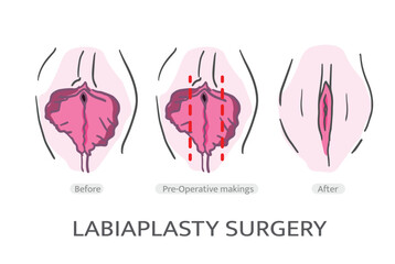 LABIAPLASTY surgery TECHNIQUES. Labiaplasty Vector. Types of female labia - obrazy, fototapety, plakaty