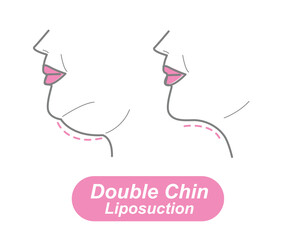 Double Chin Liposuction , liposuction vector - obrazy, fototapety, plakaty
