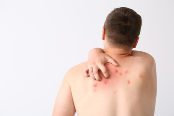 Naklejka premium Teenager ill with monkeypox on light background
