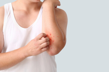Teenager ill with monkeypox on light background, closeup