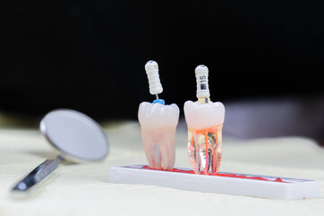 dental endodontics  - obrazy, fototapety, plakaty