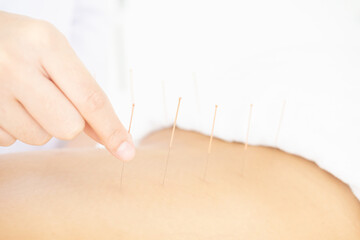Close up of hand of doctor inserting acupuncture needle on back of patient. - obrazy, fototapety, plakaty
