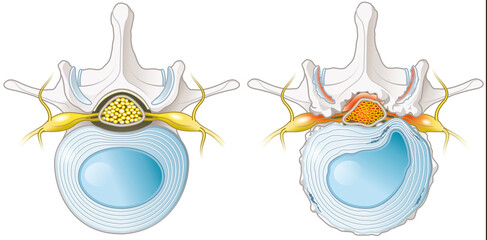 Spinal Canal Stenosis. Lumbar vertebra with intervertebral disc and herniated nucleus pulposus, illustration - obrazy, fototapety, plakaty