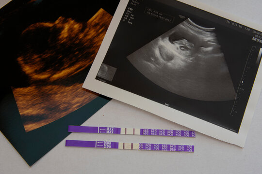 Pregnancy test HCG with photo of baby.