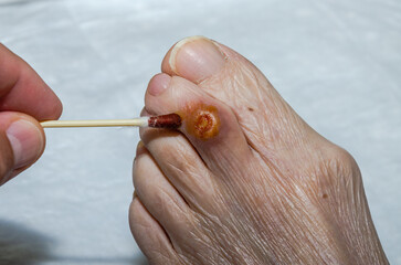 The doctor treats a purulent wound on the leg of an elderly patient with a healing ointment	
