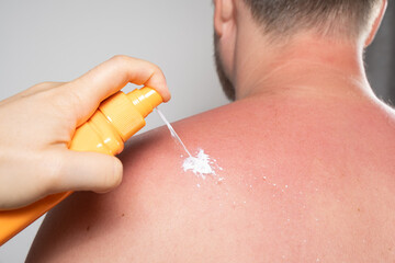 Applying sunscreen or therapeutic spray to the skin of a man with a sunburn